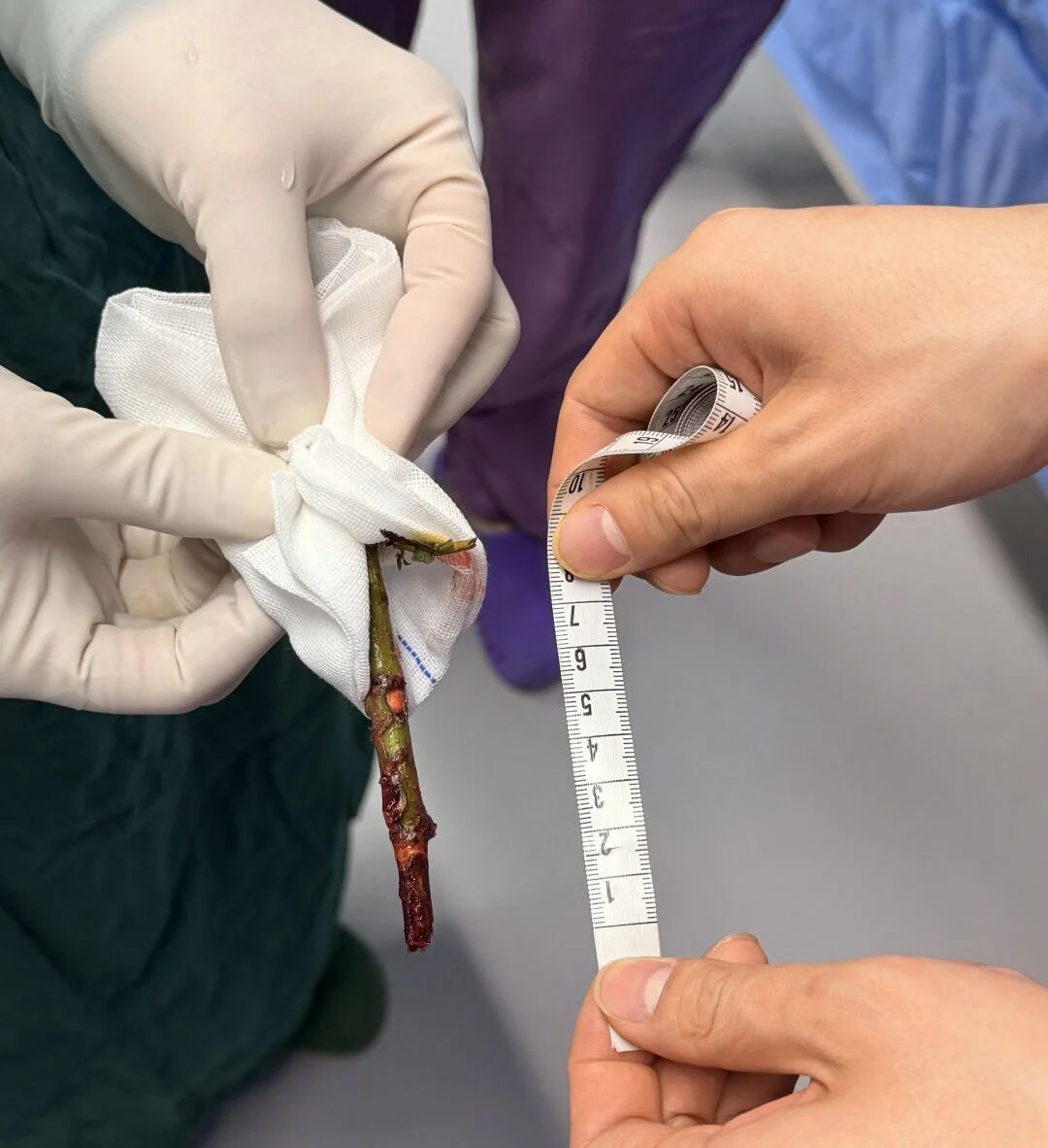 16岁少年眼眶插入8厘米树枝 医院多学科团队接力救治转危为安(图3) 16岁少年眼眶插入8厘米树枝 医院多学科团队接力救治转危为安(图3)