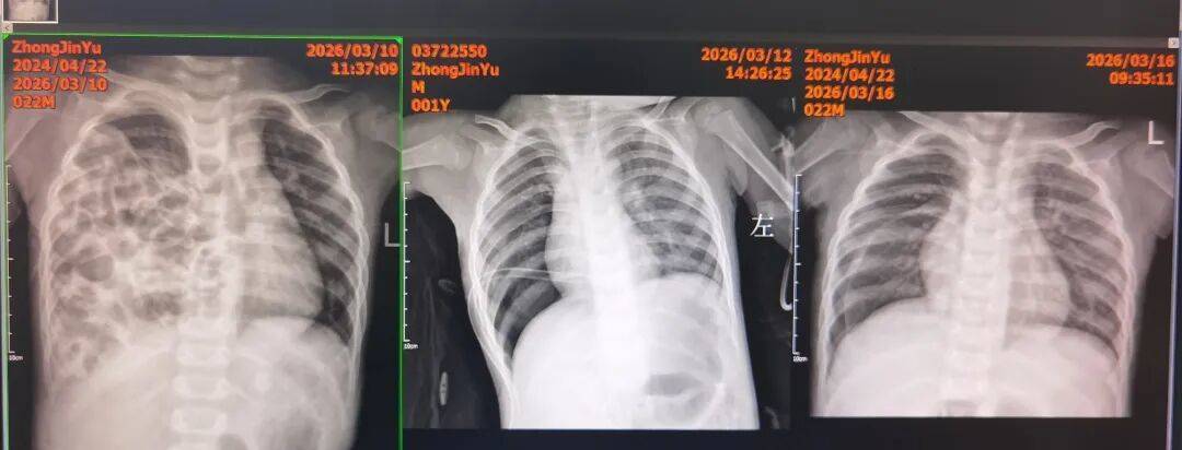 1岁娃反复咳嗽10天，医生：肺都快被肠子“挤没了”！(图2)